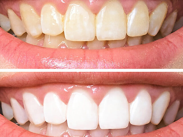 Albirea dinților: sfaturi și proceduri recomandate
