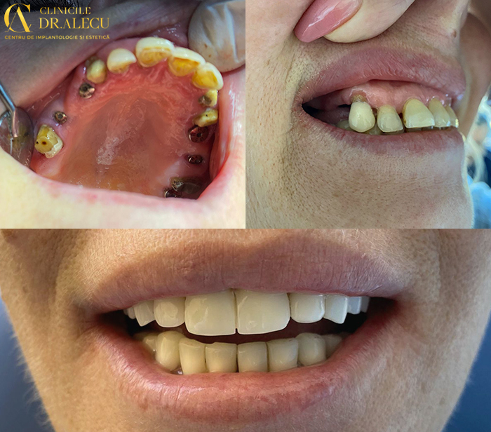 implant https://cliniciledralecu.ro/wp-content/uploads/2022/11/implant-640x563.jpg