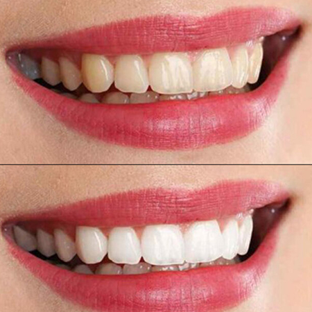 3 Metode de pentru a-ti albi dintii acasa